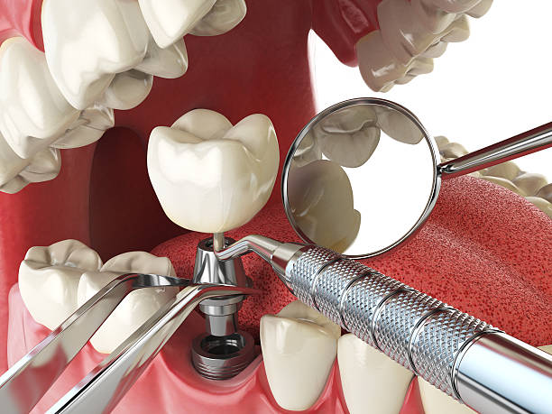 Best Knocked-Out Tooth (Avulsed Tooth) Treatment in Eden Isle, LA